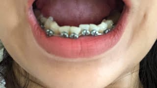 Timelapse 1 year Before and After Braces lower Shorts braces [upl. by Ahsiruam94]