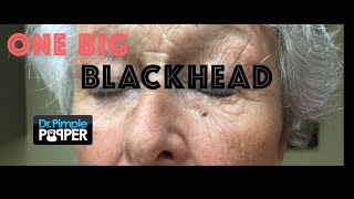 One big blackhead just for Cliffo in Queensland AU Listen to HOTFM Townsville [upl. by Countess]