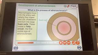 KS4GCSEBIOLOGYOrganisationThe process of atherosclerosis [upl. by Anelehs]