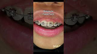 Disking for Flared Teeth orthodontist braces asmr [upl. by Aivatnohs]