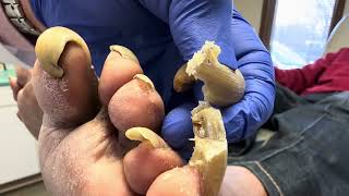 Unbelievable Toenails so long and painful that patient cannot walk [upl. by Haleak]