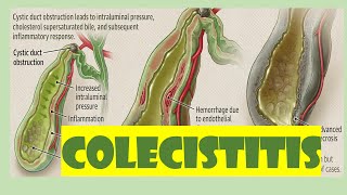 COLECISTITIS ETIOLOGÍA FISIOPATOLOGÍA DIAGNÓSTICO Y TRATAMIENTO [upl. by Eldreeda]