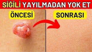 Siğilleri BİR GECEDE Yok Eden Doğal İlaç Siğiller Sağlığınız Hakkında Sizi Uyarıyor [upl. by Questa593]