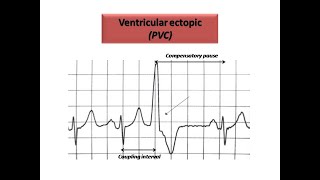 ECG course Ectopics in ECG Dr Sherif Altoukhy [upl. by Ib]