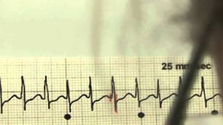 EKG für Pflege Teil 19  Supraventrikuläre Tachykardie interpretieren [upl. by Rosella]