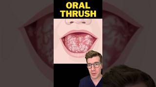 Doctor explains ORAL THRUSH in babies shorts [upl. by Eulalee]