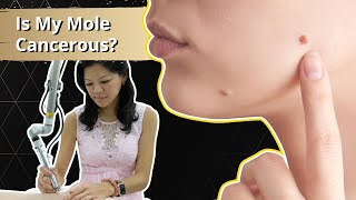 Mole or Melanoma Is My Mole Cancerous  Radium Medical Aesthetics [upl. by Analiese853]