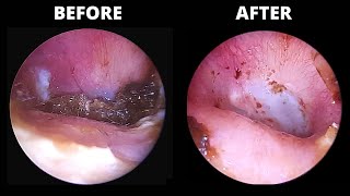 Infection and Ear Wax BEFORE AND AFTER Antibiotic Drops 928 Otomize [upl. by Farrish864]