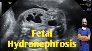 Antenatal fetal Hydronephrosis Causes  Pregnancy me bache ki kidney me sujan kyu Hoti hai [upl. by Key]