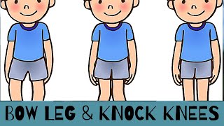 Bow leg and Knock Knees in Children when is it normal and when should we consult our Pediatrician [upl. by Adnael]