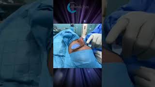 عملية تجميل الأنف Rhinoplastie ultrasonique preservationrhinoplasty [upl. by Mali57]