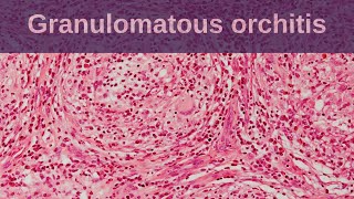 Idiopathic Granulomatous Orchitis  Pathology mini tutorial [upl. by Nahtad968]