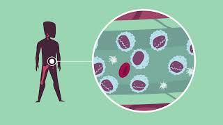 CLL  Qu’estce que la leucémie lymphoïde chronique [upl. by Yolanthe]