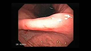 Video clip of an Upper Endoscopy [upl. by Sigismund449]