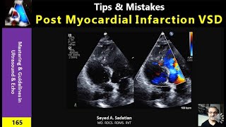 Tips amp Mistakes Ventricular Septal Rupture [upl. by Hamachi]