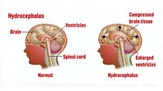 MENINGITIS BRAIN FEVER [upl. by Brunelle]