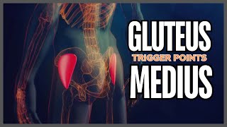 Understanding Gluteus Medius Trigger Points [upl. by Adnohsel]