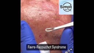 FavreRacouchot Extraction Spree [upl. by Ransell]