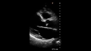 Congestive Heart Failure – Ultrasound Image Interpretation [upl. by Ardeen]