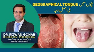 Treatment of Geographic Tongue👅😛 geographic tongue treatment [upl. by Ihcur]