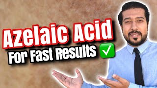 Azelaic Acid for Melasma  How to Use Azelaic Acid for SUCCESS 🏆 [upl. by Marmawke90]