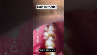 Dentist Teeth Filling Video Teeth Cavity teethcare [upl. by Rockwood]