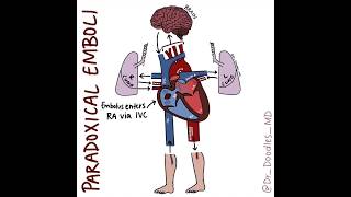 Embolic Events Stroke vs PE vs Paradoxical Emboli [upl. by Beshore]