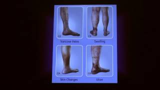 Treatment Options for Superficial Venous Disease  Cheryl Hoffman MD  UCLA Health [upl. by Turpin764]