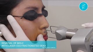 Removal Of Mole With Laser Co2 Fractionated DEKA  Dr César Calderón [upl. by Ahsaercal]