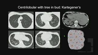 Micronodular Lung Disease [upl. by Chien]