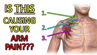 Fix Thoracic Outlet Syndrome Is THIS Causing Your Arm Pain or Tingling [upl. by Bolanger420]