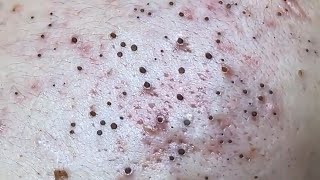 Blackheads amp Whiteheads Satisfying Removal 0027 [upl. by Gee806]