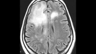 Progressive Multifocal Leukoencephalopathy [upl. by Amikahs]