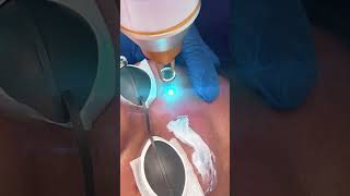 Eliminación de tatuajes con láser miami belleza depilacionlaser laserhairremoval [upl. by Reiner]