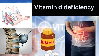 Fear Consequences of Vitamin D deficiency vitamin d [upl. by Anippesuig233]