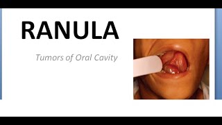 ENT Ranula Tumors of oral cavity Below tongue swelling mass round cyst plunging sublingual salivary [upl. by Amimej830]