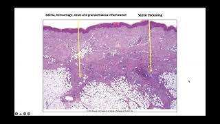 Panniculitis [upl. by Dranoel79]