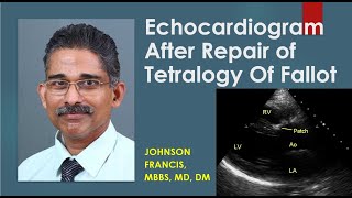 Echocardiogram After Repair of Tetralogy Of Fallot [upl. by Catriona]