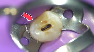 LIVE Root Canal Procedure under the Microscope w Specialist [upl. by Kcirted758]