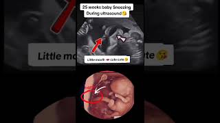 25 weeks baby sneezing during ultrasound😘😘viralvideo trending viralshorts [upl. by Semadar575]