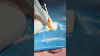 Root canal treatment amp composite restoration dentist [upl. by Hanavas608]