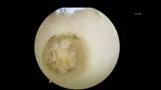 All Arthroscopic Osteochondral Autograft Transplantation for Medial Talar Dome Lesions Talus [upl. by Yrrad]