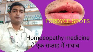 FORDYCE SPOTS cause symptoms and homoeopathic remedies [upl. by Aitnis]