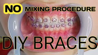 How To DIY Braces Part 2  No Mixing Procedure [upl. by Eirovi952]