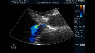 Endocarditis con Insuficiencia Aortica Aguda Dr Pedro Guillermo Bustos Febrero 2011wmv [upl. by Nnaecyoj]