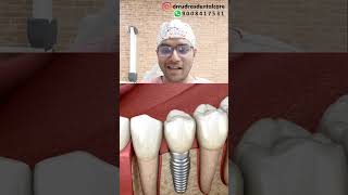 Dr Rudra Mohan  dentalimplants conventionalimplants replacingmissingteeth missingteeth dental [upl. by Ailefo]