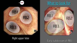 Mastering Bronchoscopy for Thoracic Surgery Chapter 2 [upl. by Neda393]