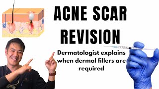 How to treat ACNE SCARS  Dermal Fillers [upl. by Airat]