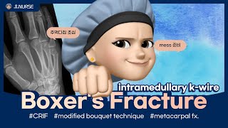 CRIF5th metacarpal fractureintramedullary kwire [upl. by Amoritta]