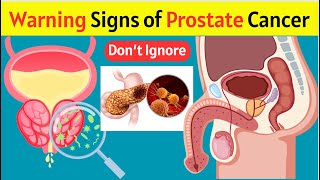 Warning Signs of Prostate Cancer  Prostate Cancer Signs  Prostate Cancer Symptoms [upl. by Bokaj]